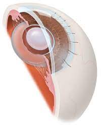 CATARACT ECCE with IOL Single Eye