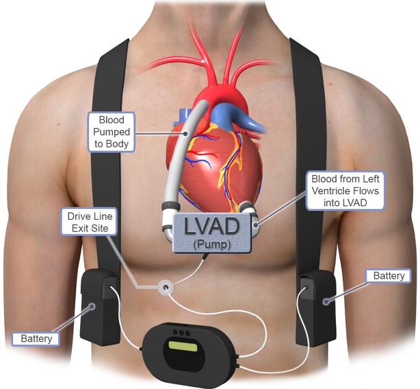 LVAD - Left Ventricular Assist Device Surgery