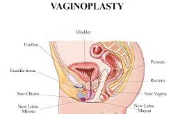 Vaginoplasty
