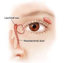 ORBIT AND OCULOPLASTY-DCR (Dacryo Cysto Rhinostomy) Surgery