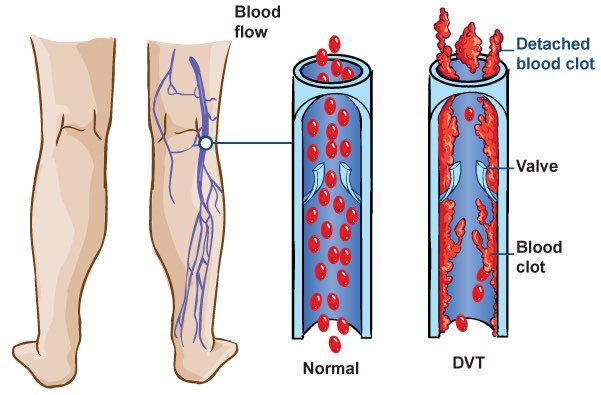 Thrombosis