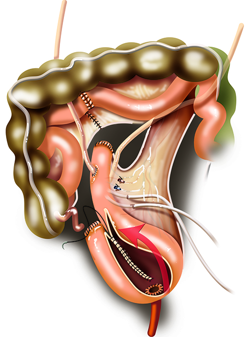 Cystectomy Radical and Orthotopic Bladder