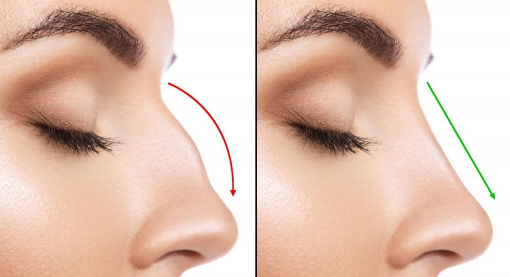 Rhinoplasty-Secondary