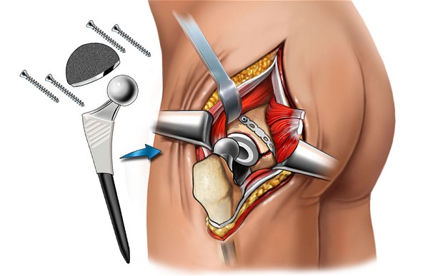Total Hip Replacement UL