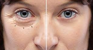 Blepharoplasty Eyelid Lift (Lower Lids Only)