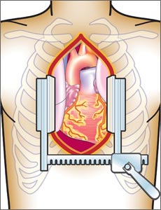 CABG Robotic Surgery