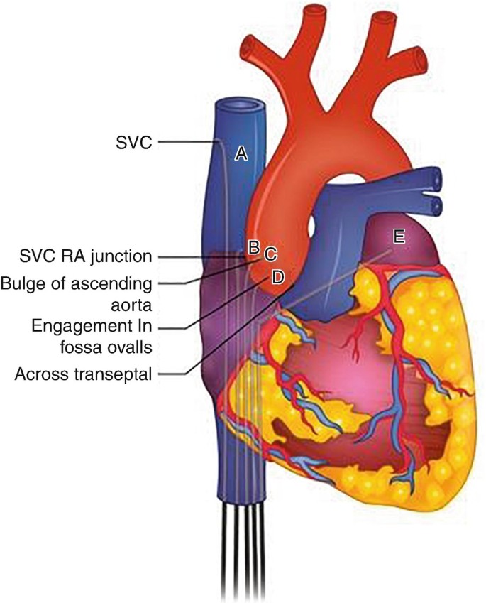 PTMC (Percutaneous Transvenous Mitral Commissurotomy)