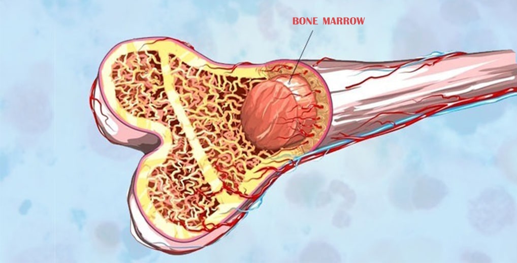 Bone Marrow Transplant Allogenic
