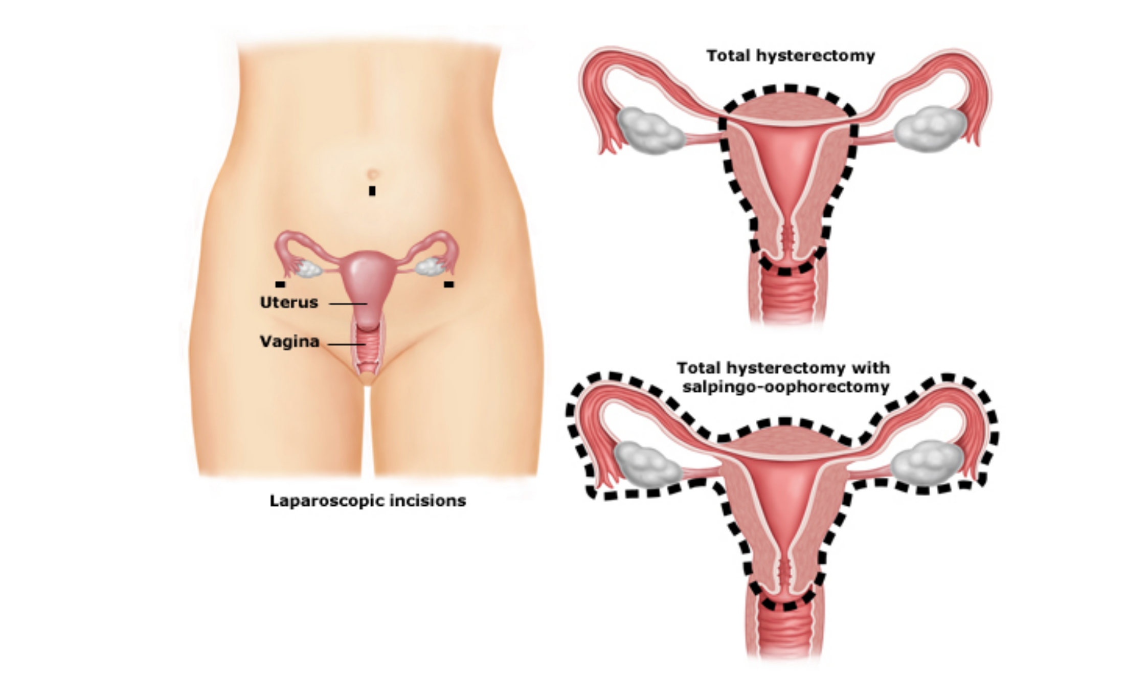 Hysterectomy