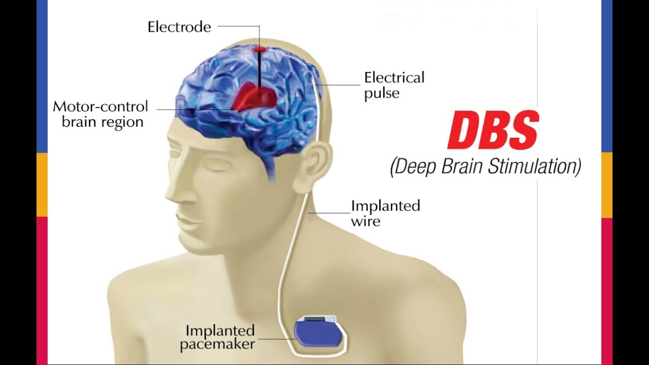 Deep Brain Stimulation - Non-Rechargeable Implant