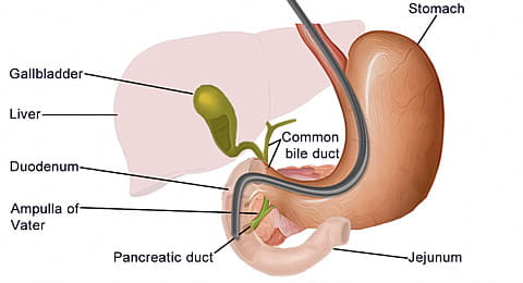 Endoscopic retrograde cholangiopancreatography (ERCP)