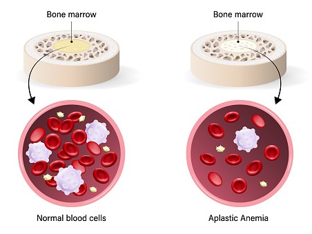 Aplastic Anemia Treatment