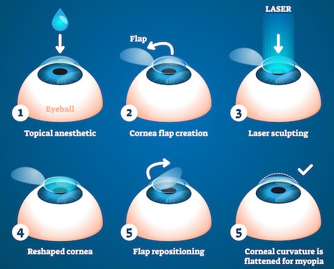 LASIK Surgery Both Eyes