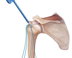 Rotator Cuff Surgery