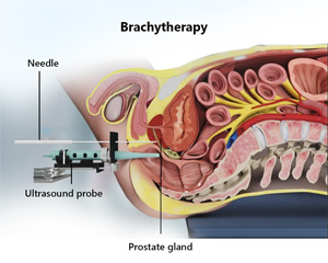 Brachytherapy