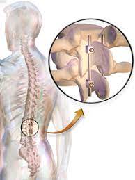 Spinal Fusion Surgery