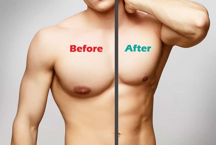 Gynecomastia Treatment