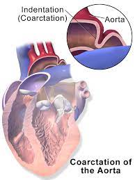 Aortic coarctation