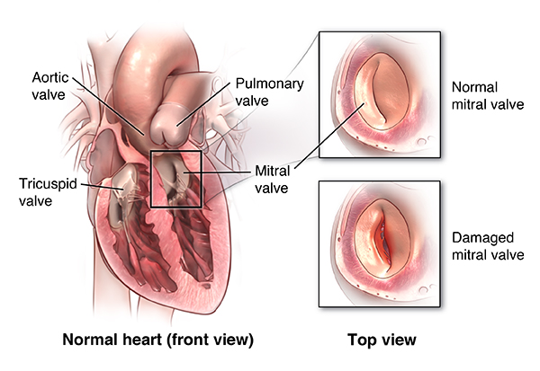 Mitral Valve Repair