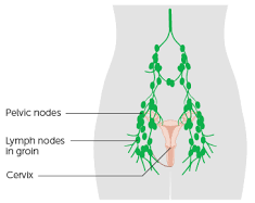 Radical Hysterectomy with Lymph Node Dissection