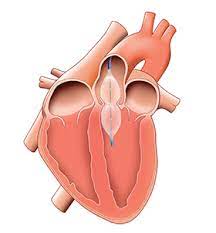 Balloon Aortic Valvuloplasty