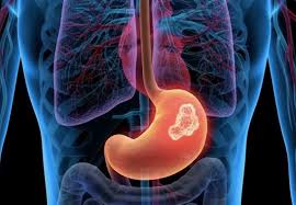 Stomach Cancer Treatment