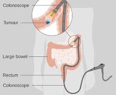 Colon Cancer Treatment
