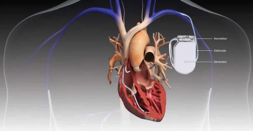 Biventricular Pacemaker Surgery