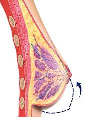Breast Lift (Mastopexy)