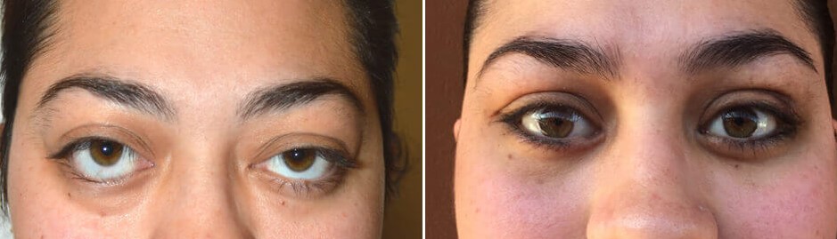 Orbital Decompression Surgery