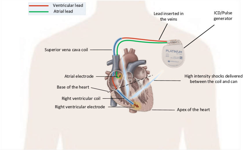 Single Cavity or Double Cavity ICD