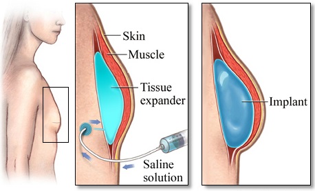Breast Reconstruction with Implant