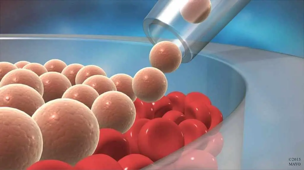 Bone Marrow Transplant Allogenic