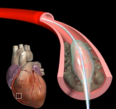 Balloon Angioplasty