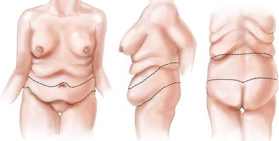 Body Lift Surgery