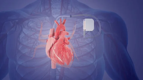 Biventricular Pacemaker Surgery