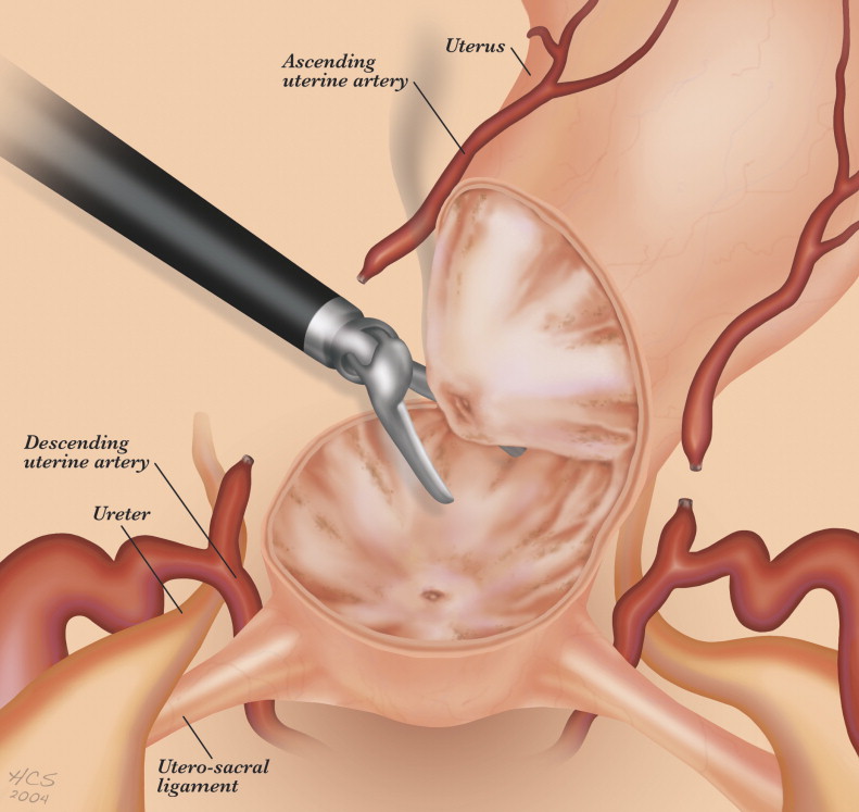 Laparoscopic Supracervical Hysterectomy