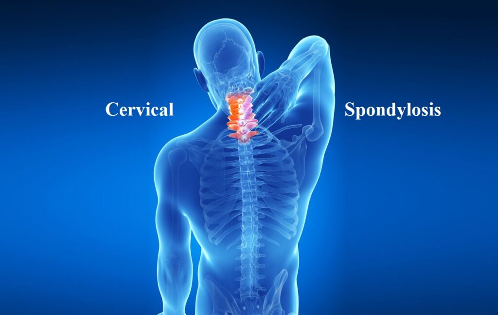 Ayurveda Treatment for Cervical Spondylosis