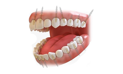 Dental Implant