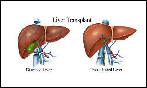 Liver Transplant, India