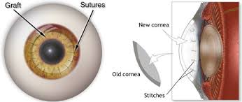 Cornea Surgery