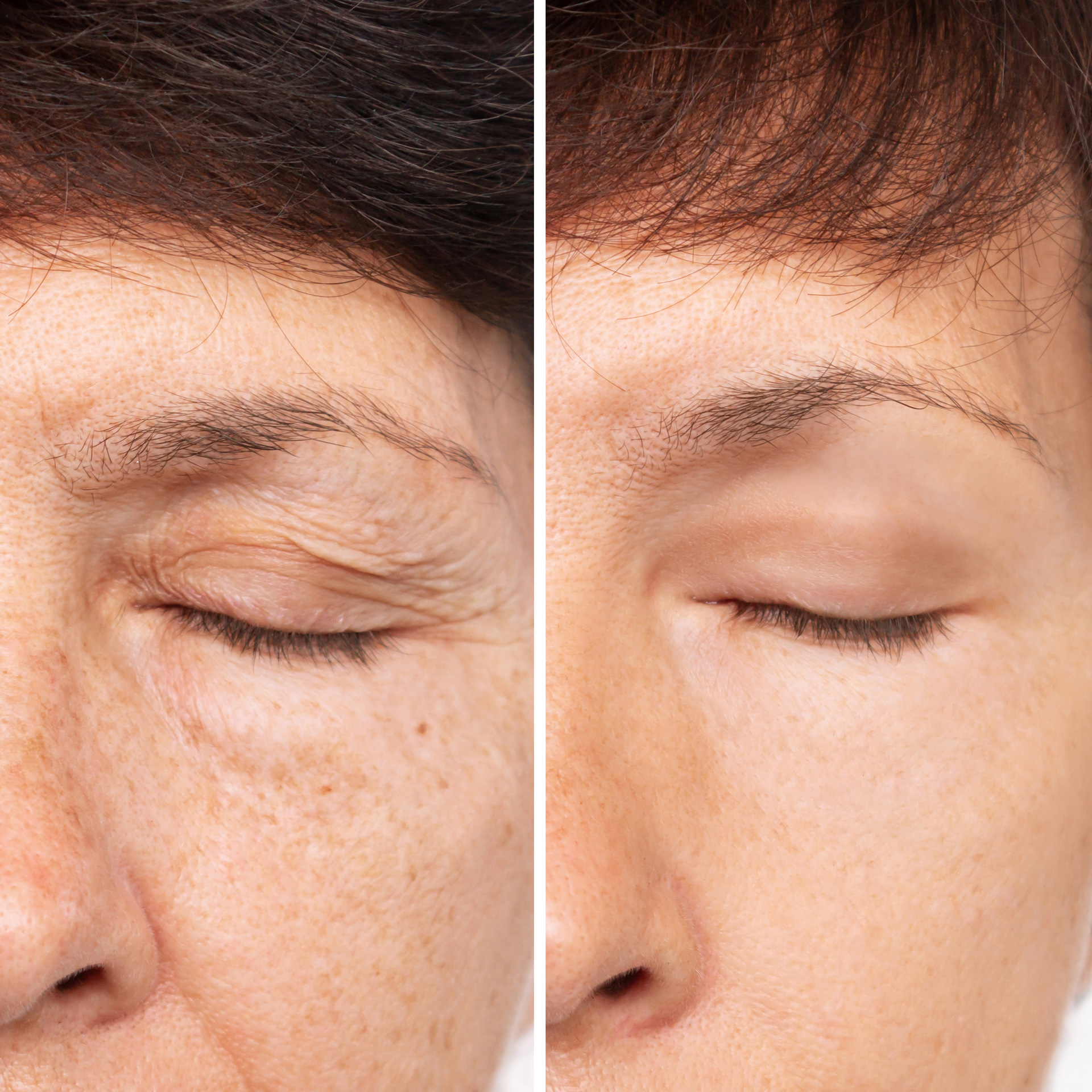 Blepharoplasty Eyelid Lift (Upper Lids Only)