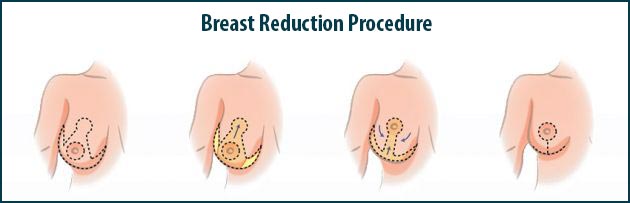 Breast Reduction