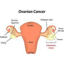 Ovarian Cancer Treatment
