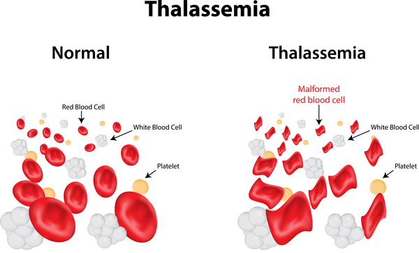 Thalassemia Treatment