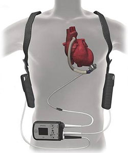 LVAD - Left Ventricular Assist Device Surgery