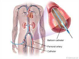 Single vessel angioplasty