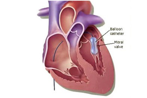 Balloon Mitral Valvuloplasty