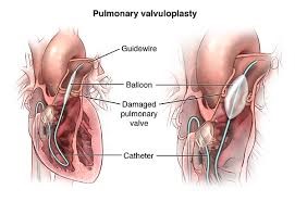 Balloon Pulmonary Valvuloplasty