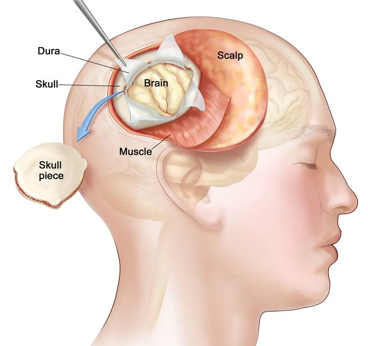 Pituitary Tumor Treatment